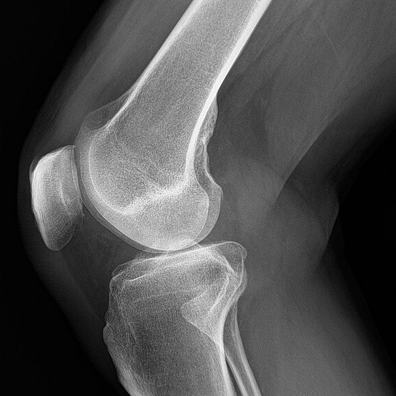 Radiograph of the a knee. Photo: Ptrump16 @ Wikipedia